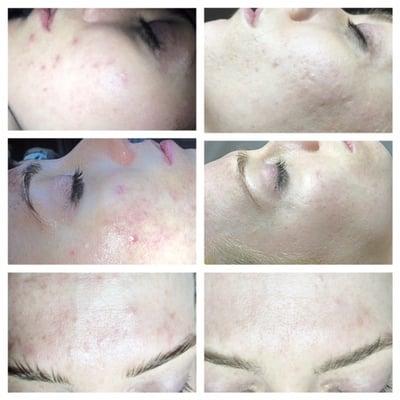 PROOF! A client of SBB who came in for acne and followed a system of facials and peels for 4 visits, and the used recommended skin care!