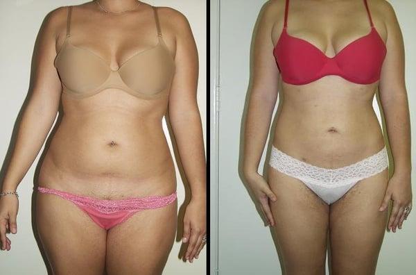 26 year old female that underwent a 2100 cc liposuction. Post operative photo taken 6 months after surgery.