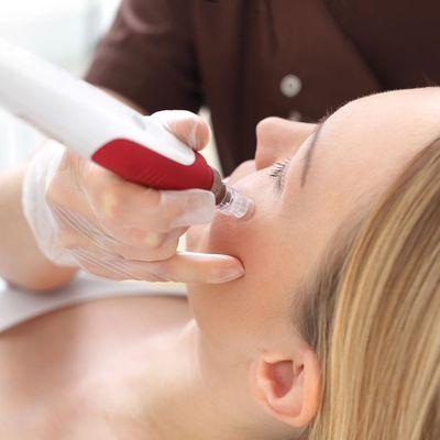 Microneedling heals wrinkles, fine lines, acne, scars, age spots (melasma), and more.