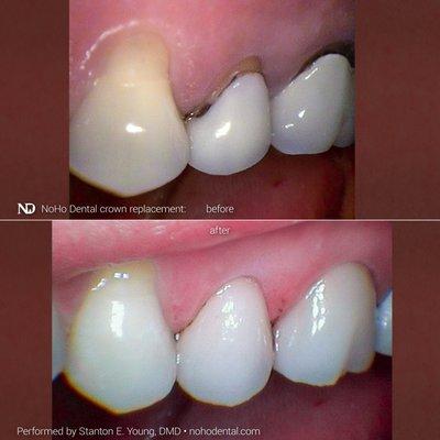 Crown margin repair: replacing this patient's crowns addressed their dental health and aesthetic concerns.