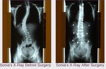 Adult Scoliosis Correction Before & After