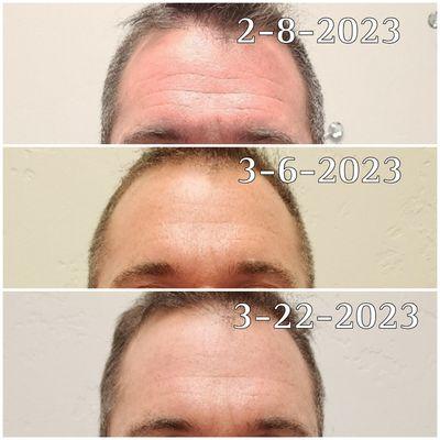 Real results from locals. 2x per week for 20 minutes.
Take a nap while the light therapy reverses times aging!