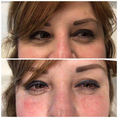 One syringe of Restylane Lyft under eye filler.  natural immediate results