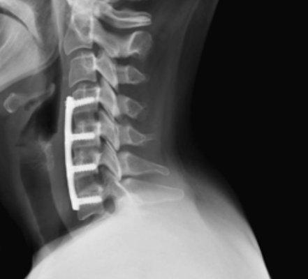 Multilevel Discectomy ,Titanium plate and screws