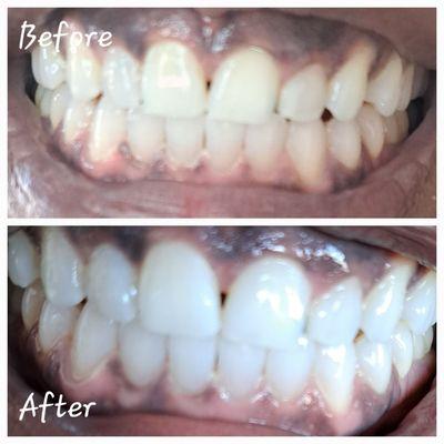 Before and After teeth whitening.