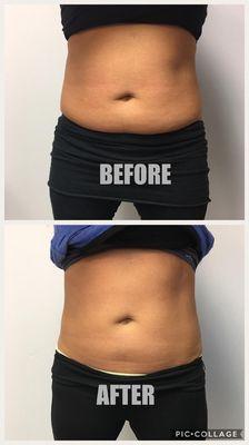 SculpSure is a non-invasive body contouring technique that targets, reduces, and permanently eliminates fat cells.