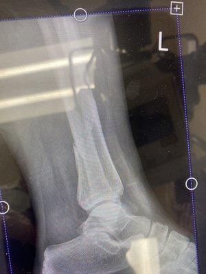 Broken tibia and fibula from a motorcycle accident 2.