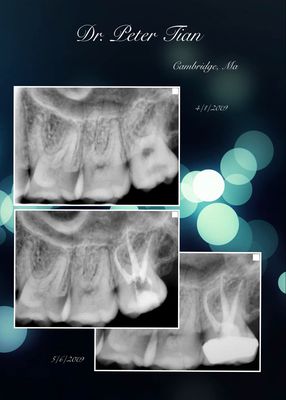 Wisdom Tooth Root canal treatment