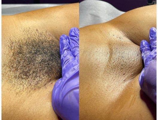 Before and after Brazilian wax