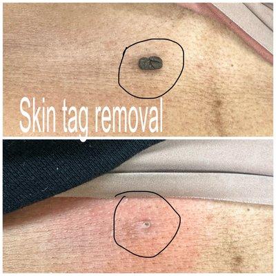 skin tag removel