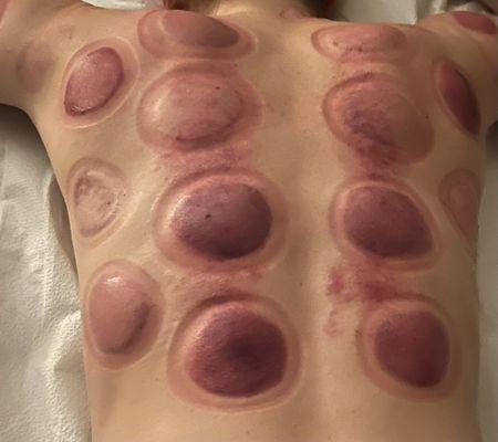 Cupping therapy