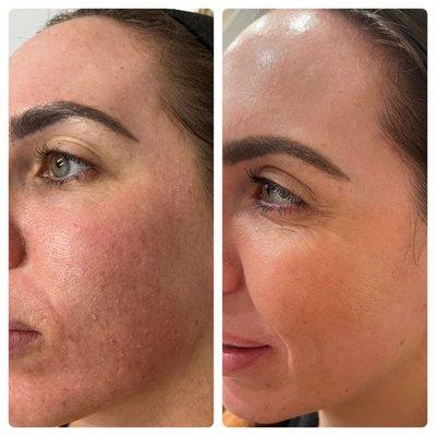 The Perfect Derma Peel