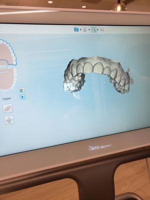 Intraoral scan... Amazing technology!