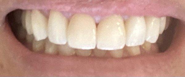 My top teeth! Had crowns done.  Going back for bottom row soon!