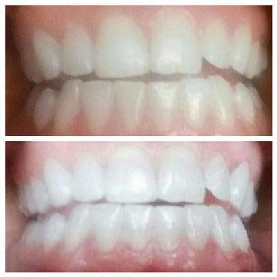 I finally had time to do my own teeth. White again! Yeah! #white_ology