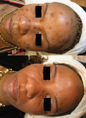 Luminosity Acne Skincare - Acne Treatment