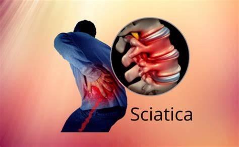 Treatment for Sciatica