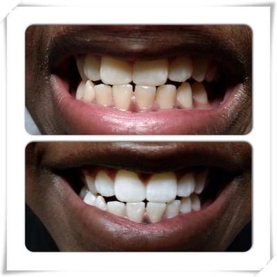 30 Minute Teeth Whitening