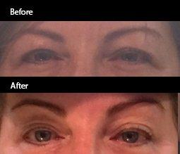 Brow Lift