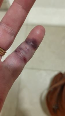 My broken finger from falling up the stairs