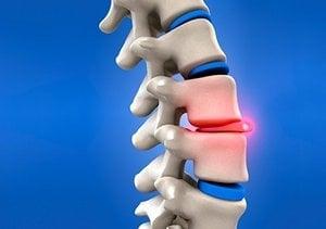 herniated disc