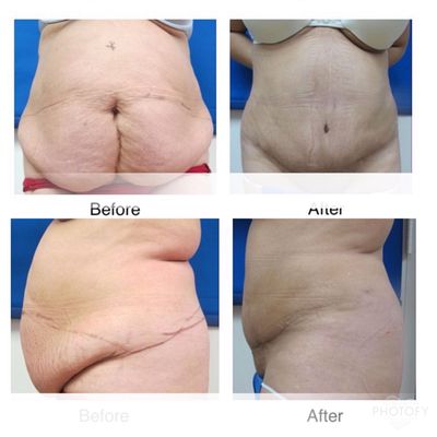 Body jet lipo/tummy tuck combo