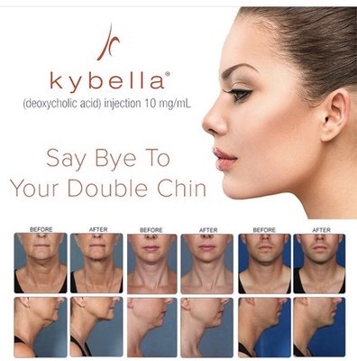 Kybella is a non invasive way to melt your double chin