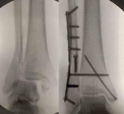 Ankle fracture