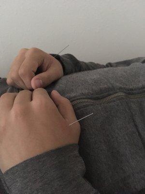 For depression he only needed 6 needles