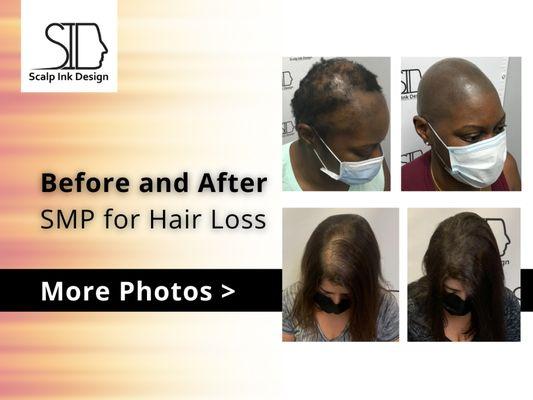 Before and after photos - women smp for hair loss