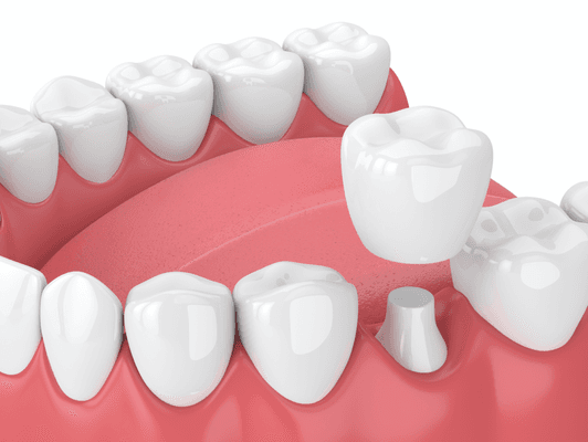 A dental crown is a restorative procedure to protect or replace a tooth.