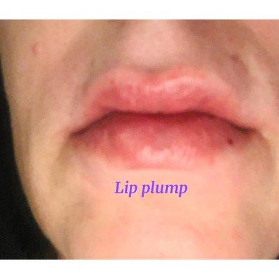 Lip plump