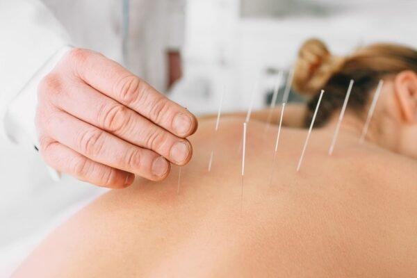 Acupunture services