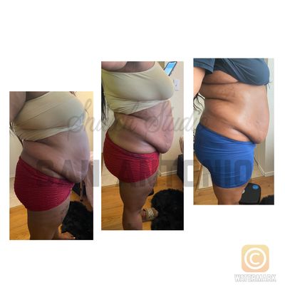 2 Laser Lipo Tummy Sessions