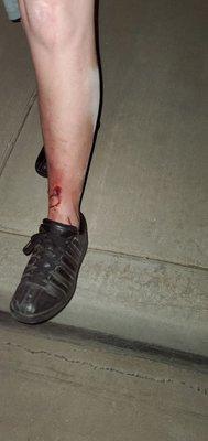 Husband's leg gash from fence