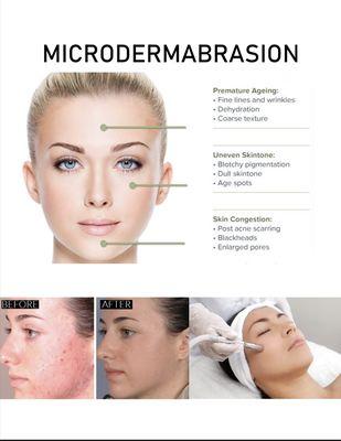 Microdermabrasion!