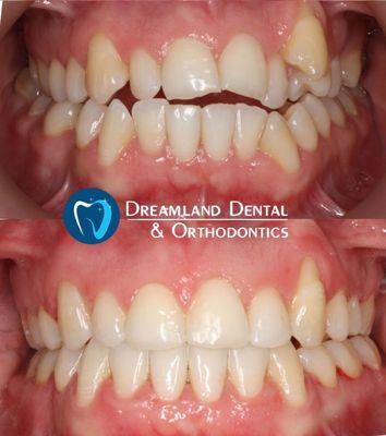 Our dentists and orthodontists in Bellflower can treat any of your needs, Dentures, Bridges Cleaning, Whitening