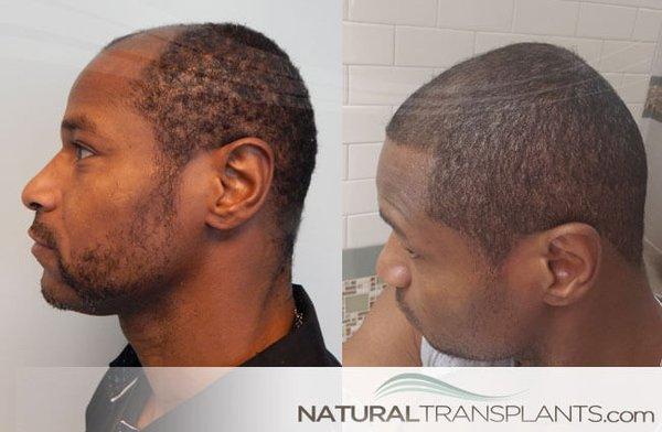 Best Hair Transplant Doctors