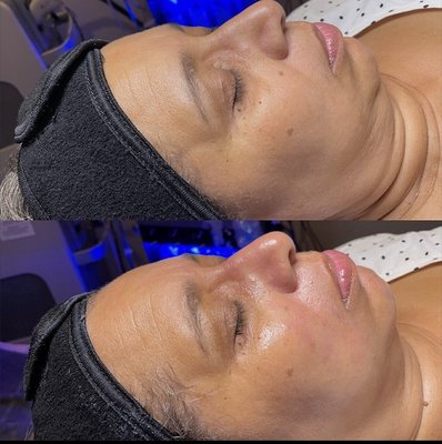 Hydrafacial before & after