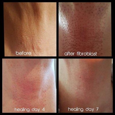 Fibroblast plasma skin tightening.