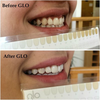 The professional whitening difference.