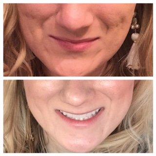 Deep pitted acne scars. Photo after 3 treatments!