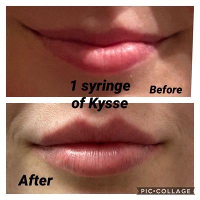 Beautiful lip augmentation!