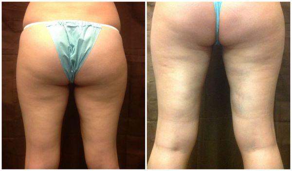 Thigh Lipo - HD Lipo