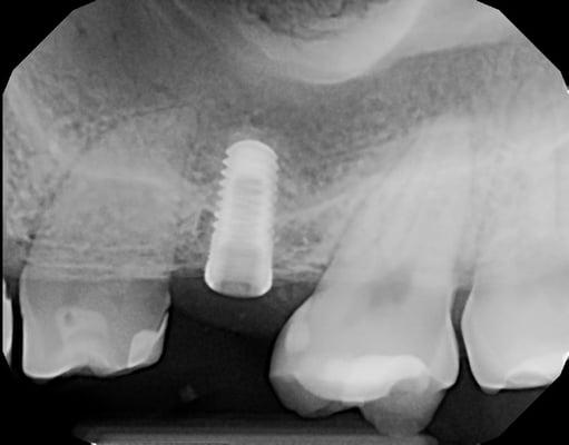 Implant Placed