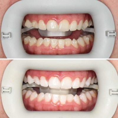 Teeth whitening services