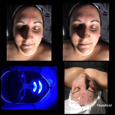 Deep pore cleanse, LED blue light therapy!