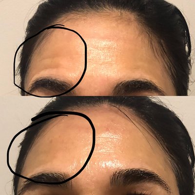 RF skin tightening treatment before and after