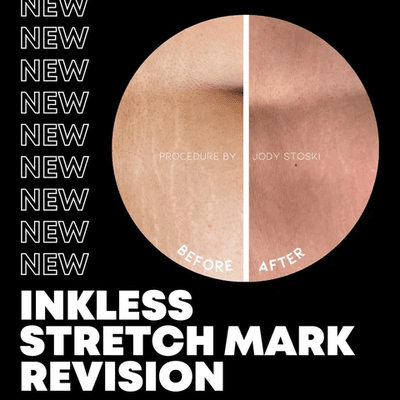 Inkless Stretchmark Removal in La Canada