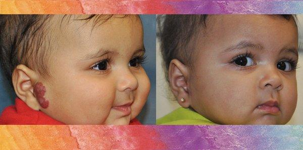 Hemangioma Before & After